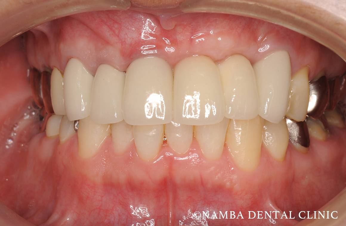前歯のインプラント症例